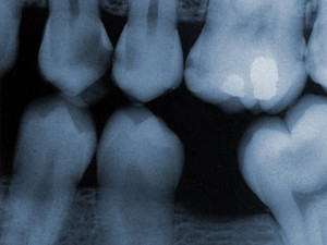 Digital x Rays