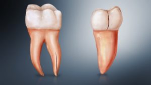 Dental fractures