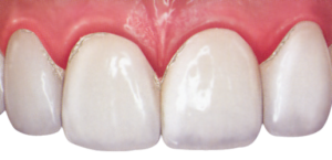 dental plaque