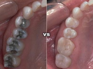 tooth colored fillings