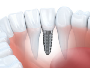 Dental Implants - Springfield VA
